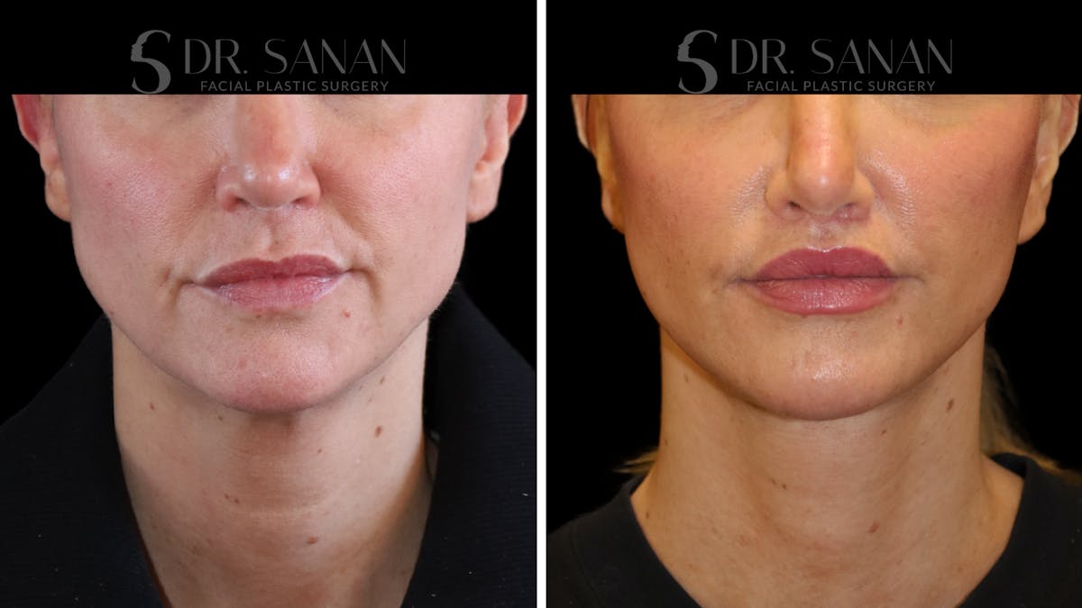 Lip Lift Before & After Gallery - Patient 303021 - Image 2