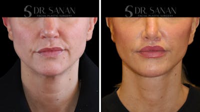 Lip Lift Before & After Gallery - Patient 303021 - Image 1