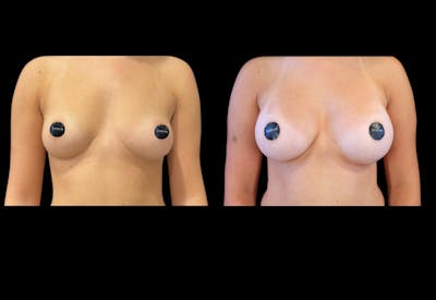 Breast Augmentation Before & After Gallery - Patient 513896 - Image 1