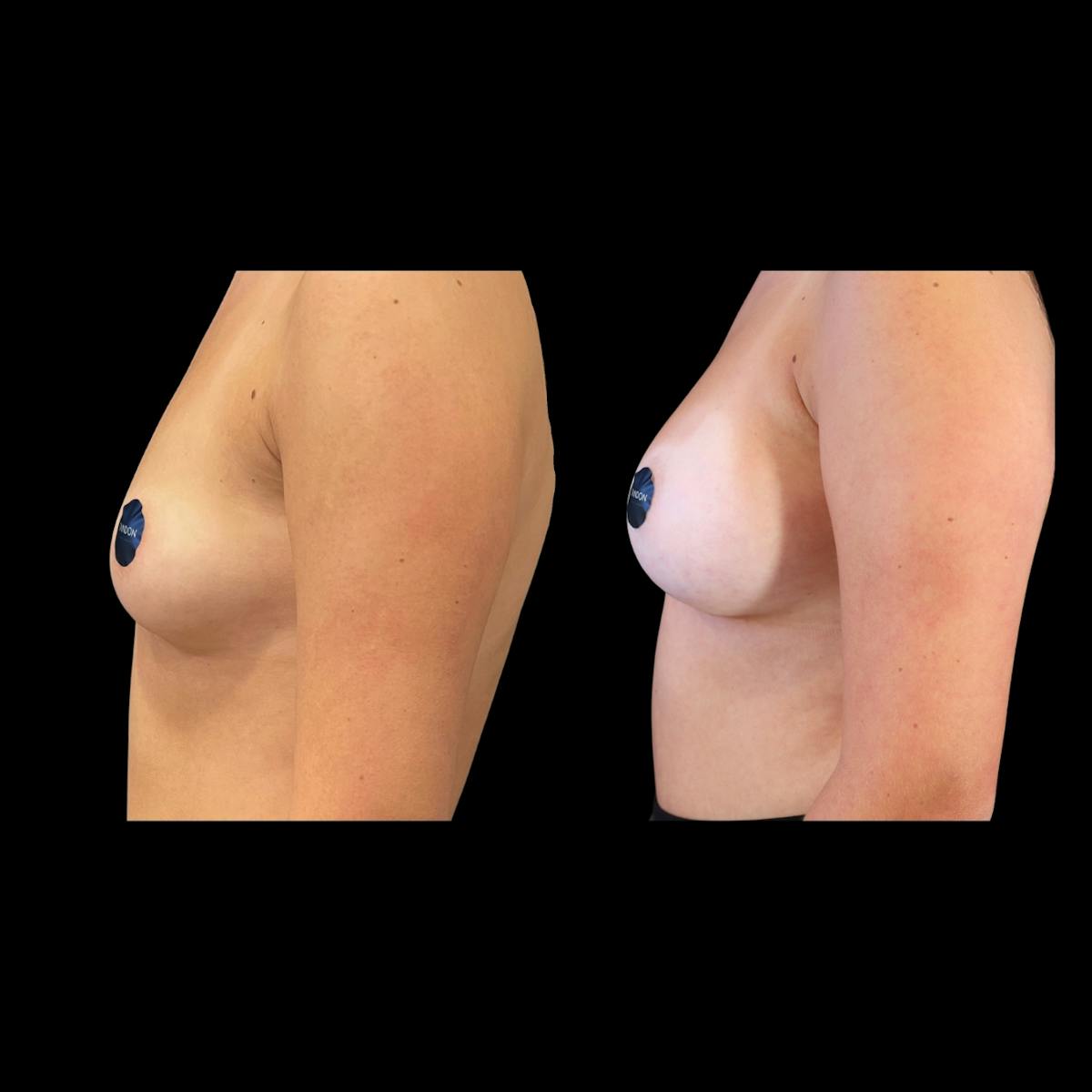 Breast Augmentation Before & After Gallery - Patient 513896 - Image 3