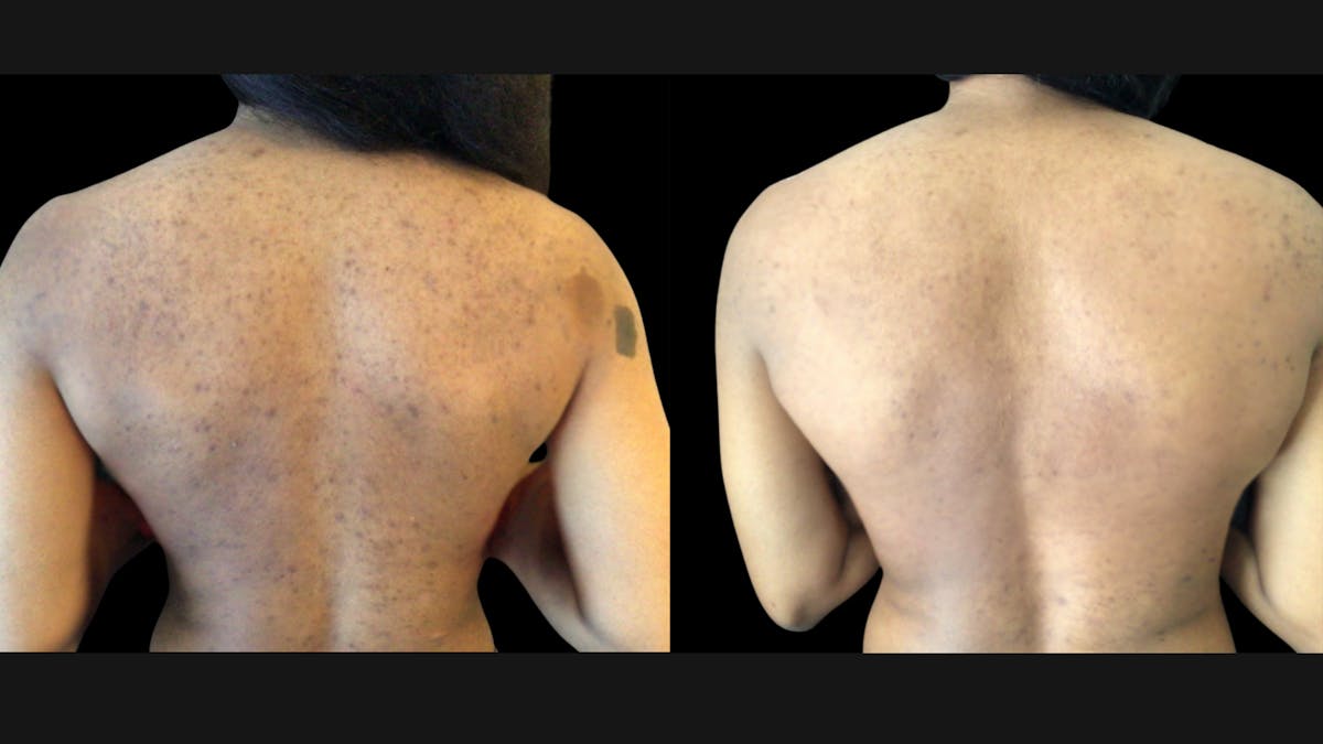 Chemical Peel Before & After Gallery - Patient 238612 - Image 1
