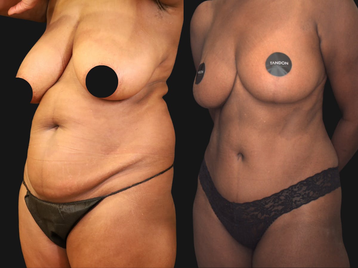Mommy Makeover Before & After Gallery - Patient 404023 - Image 3