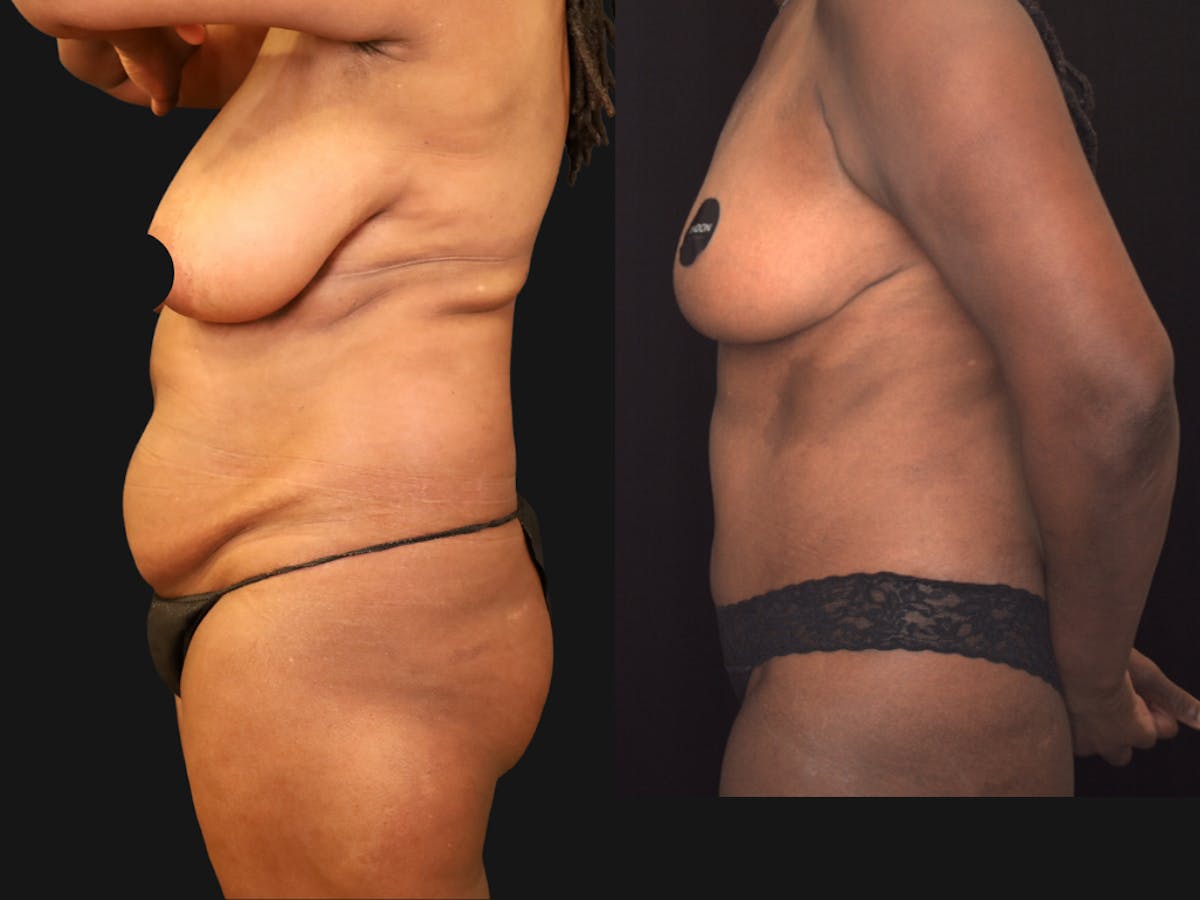 Mommy Makeover Before & After Gallery - Patient 404023 - Image 2