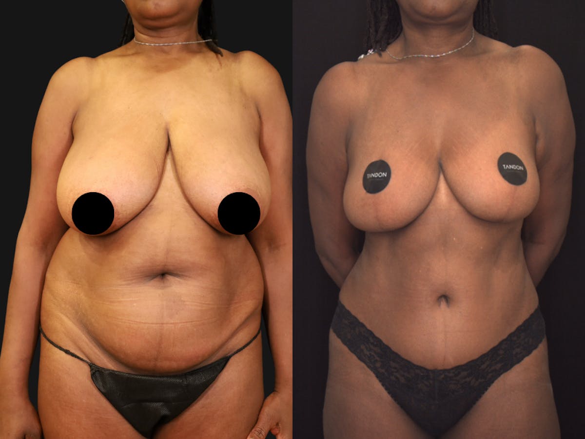 Mommy Makeover Before & After Gallery - Patient 404023 - Image 1