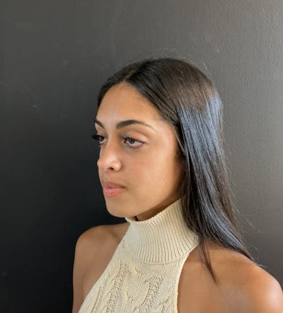 Dermal Fillers Before & After Gallery - Patient 274909 - Image 1