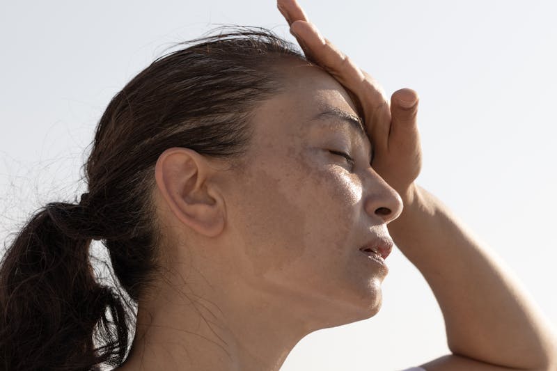 woman with hyperpigmentation in the sun