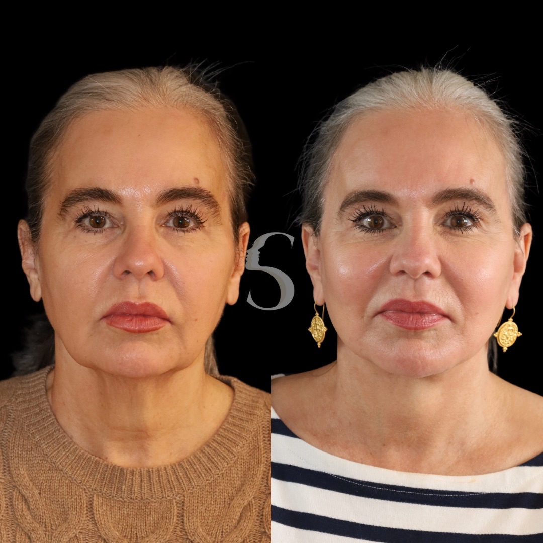 ボディ・フェイスケア photo lift 35 Patient 138349 | Deep Plane Facelift Before & After Photos