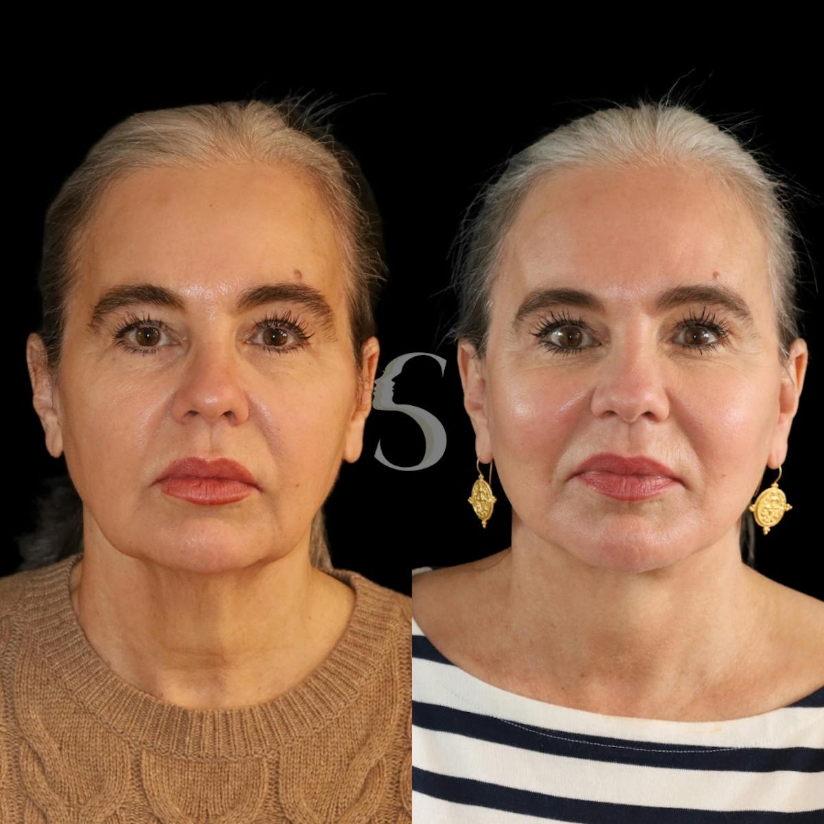 Brow Lift Before & After Gallery - Patient 291316 - Image 1