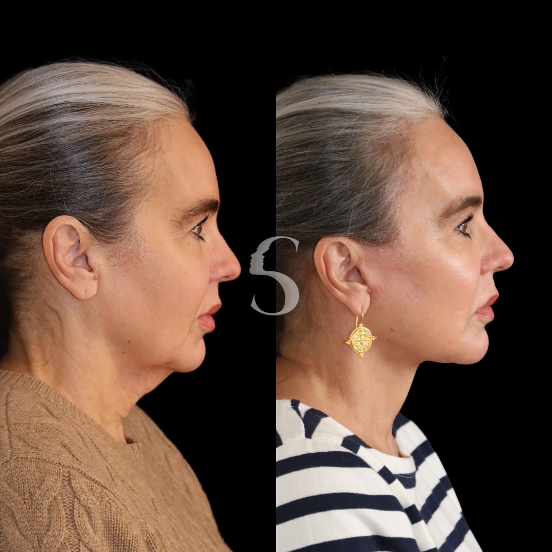 Patient 138349 | Deep Plane Facelift Before & After Photos