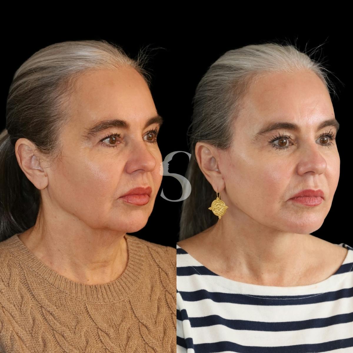 Brow Lift Before & After Gallery - Patient 291316 - Image 2
