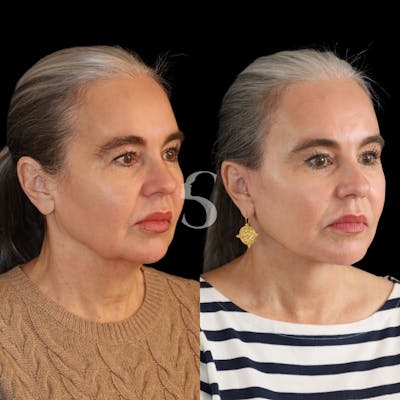 Deep Plane Facelift Before & After Gallery - Patient 138349 - Image 1