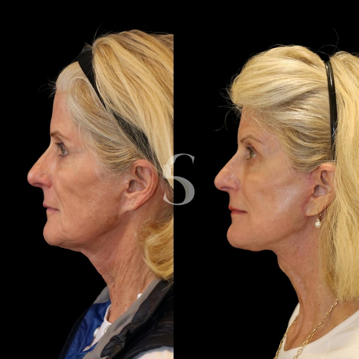 Deep Plane Facelift Before & After Gallery - Patient 370125 - Image 3