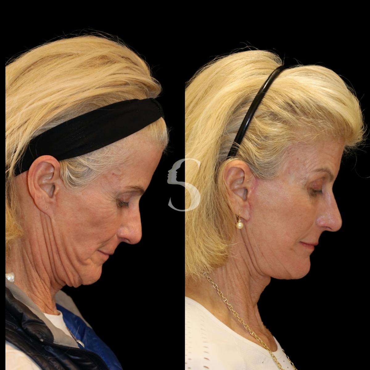 Deep Plane Facelift Before & After Gallery - Patient 370125 - Image 4