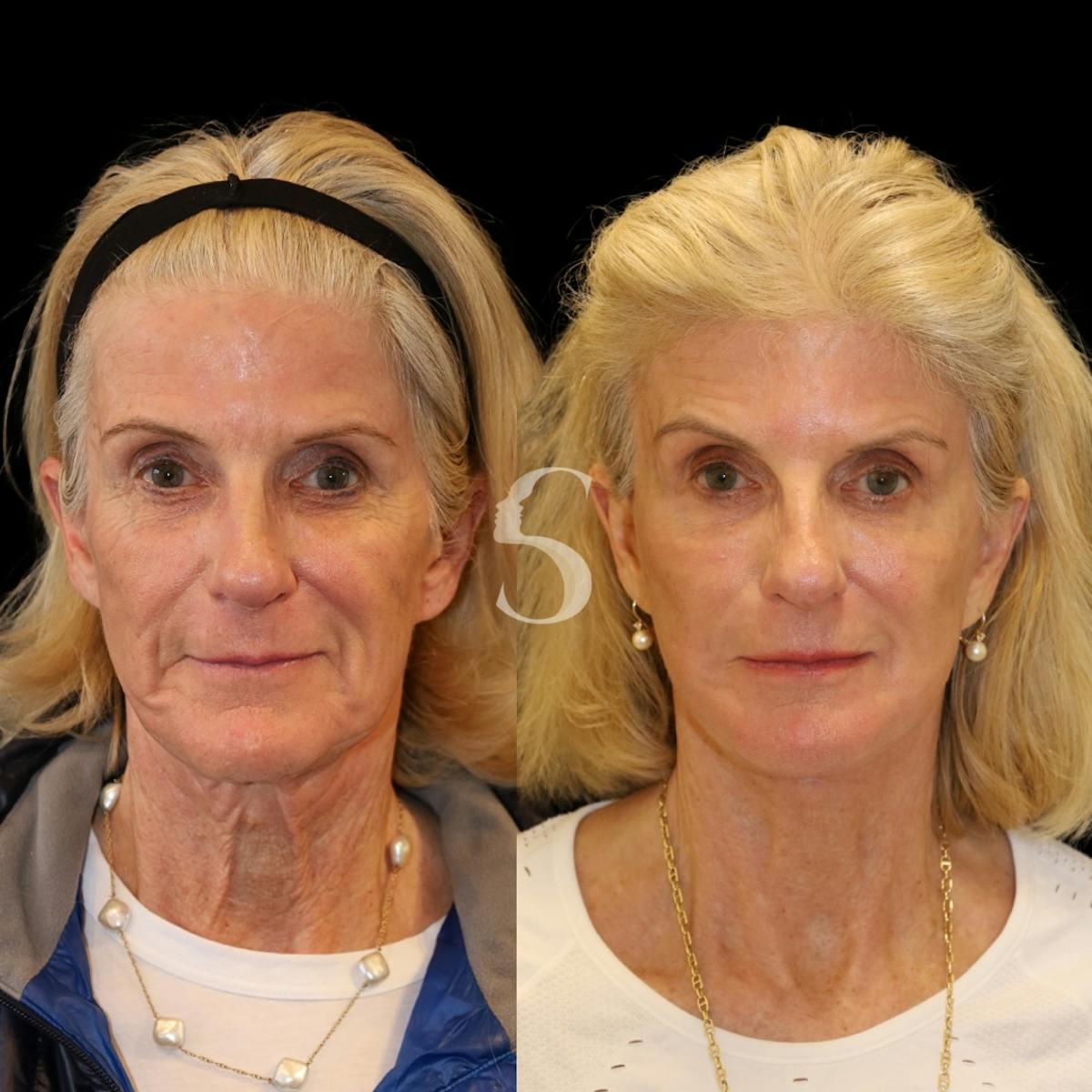 Deep Plane Facelift Before & After Gallery - Patient 370125 - Image 1