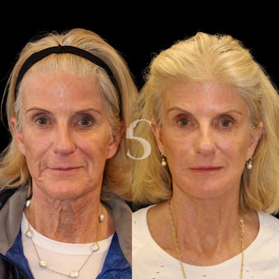 Neck Lift Before & After Gallery - Patient 402107 - Image 1
