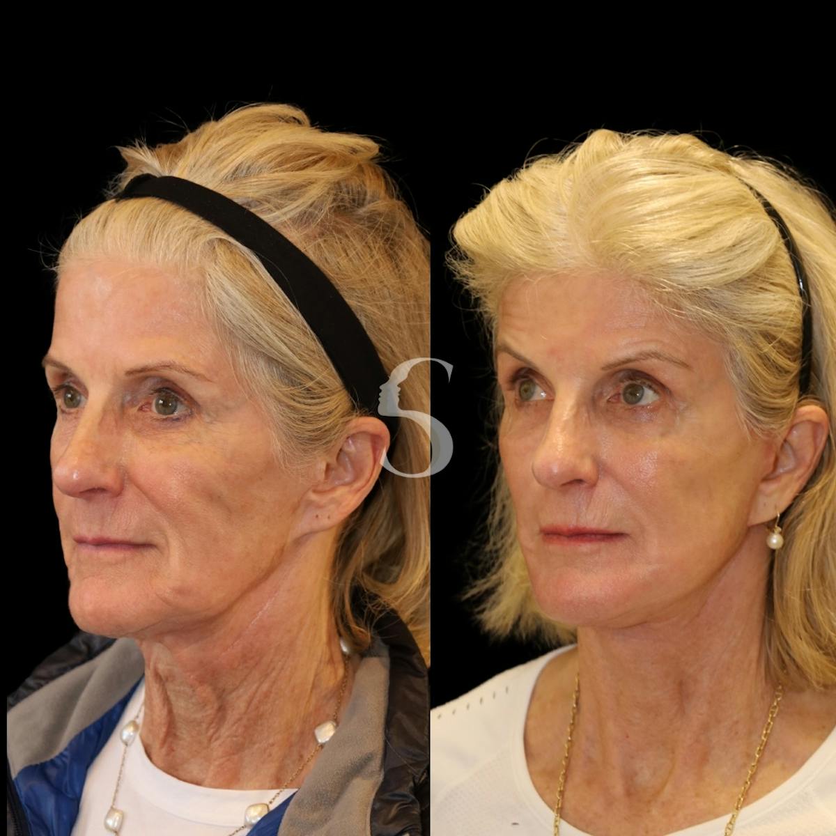 Deep Plane Facelift Before & After Gallery - Patient 370125 - Image 2