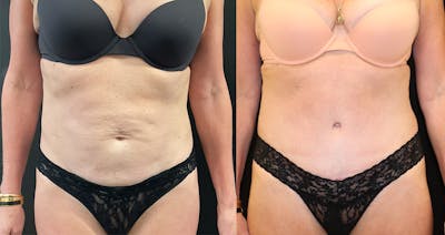 Abdominoplasty (Tummy Tuck) Before & After Gallery - Patient 312469 - Image 1