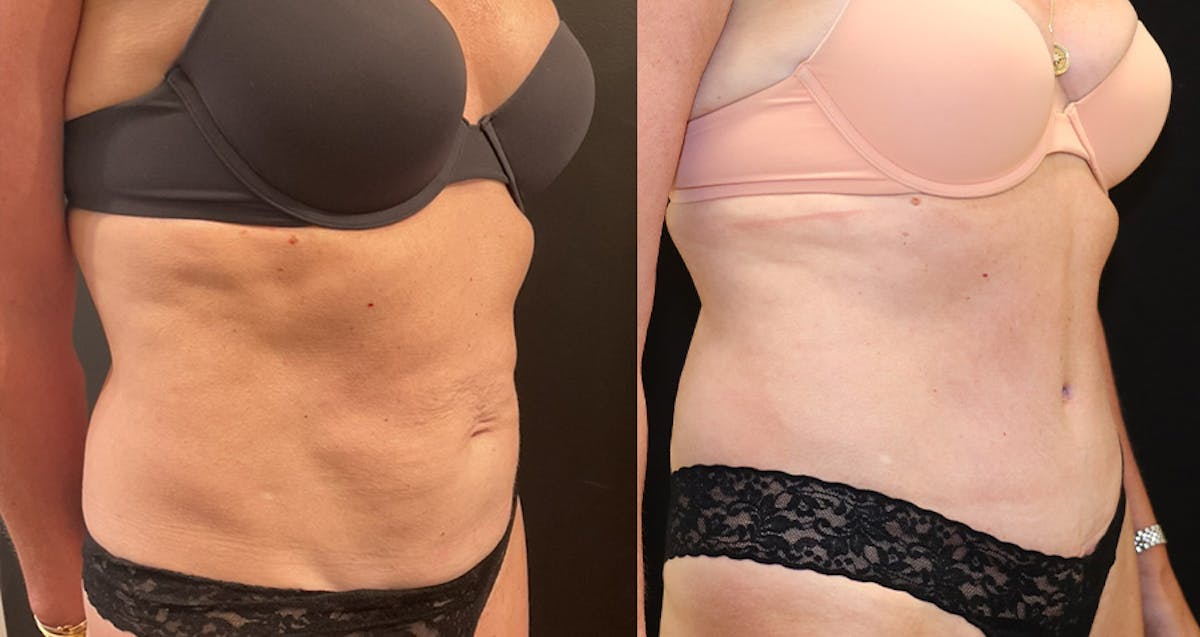 Abdominoplasty (Tummy Tuck) Before & After Gallery - Patient 312469 - Image 2
