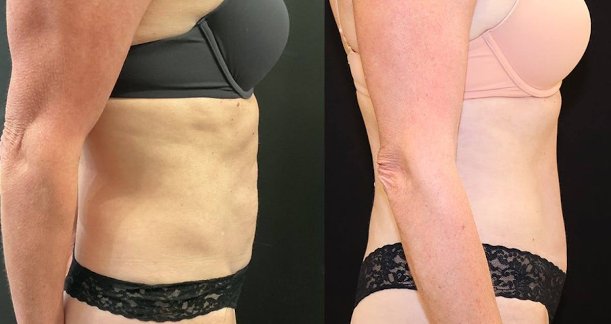 Abdominoplasty (Tummy Tuck) Before & After Gallery - Patient 312469 - Image 3