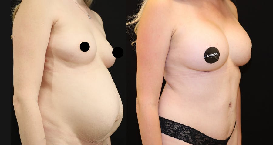 Breast Augmentation Before & After Gallery - Patient 115503 - Image 3