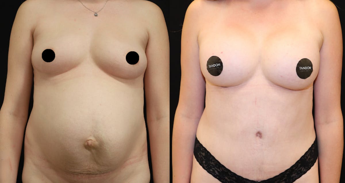 Abdominoplasty (Tummy Tuck) Before & After Gallery - Patient 338725 - Image 2