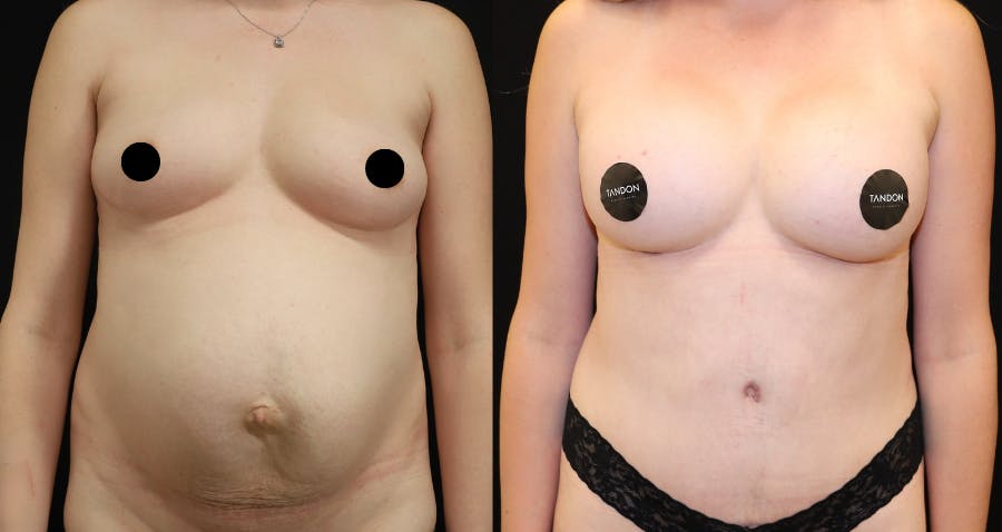 Breast Augmentation Before & After Gallery - Patient 115503 - Image 2