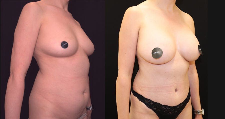 Breast Augmentation Before & After Gallery - Patient 150734 - Image 2