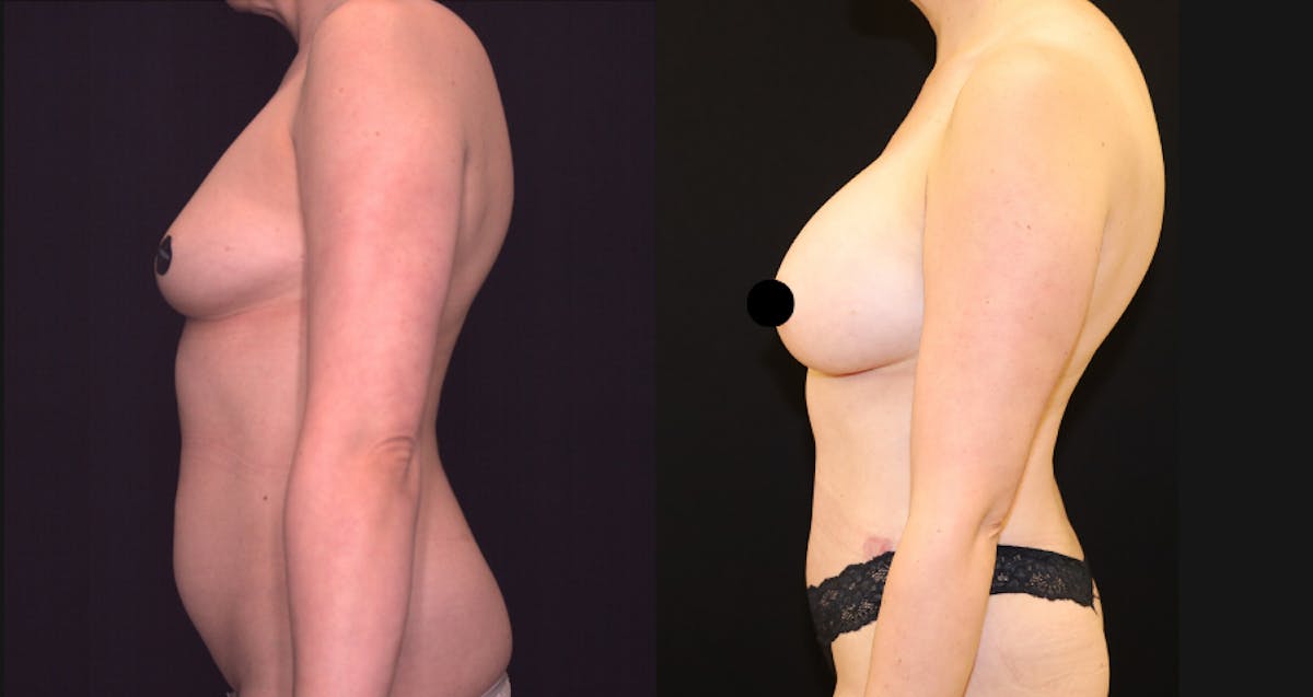 Breast Augmentation Before & After Gallery - Patient 150734 - Image 2