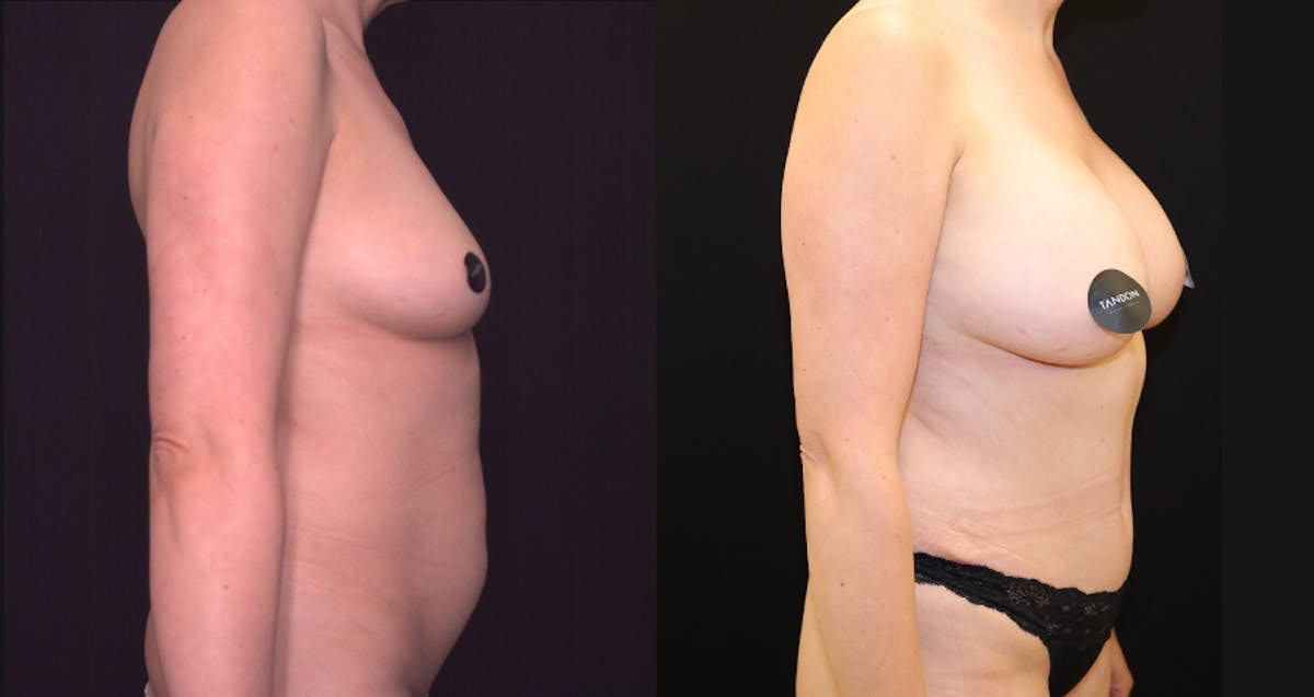 Breast Augmentation Before & After Gallery - Patient 150734 - Image 1