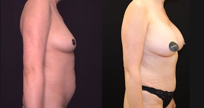 Breast Augmentation Before & After Gallery - Patient 150734 - Image 1
