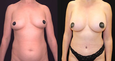 Breast Augmentation Before & After Gallery - Patient 150734 - Image 1