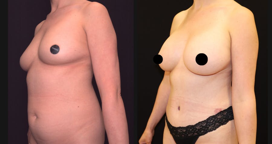 Breast Augmentation Before & After Gallery - Patient 150734 - Image 5