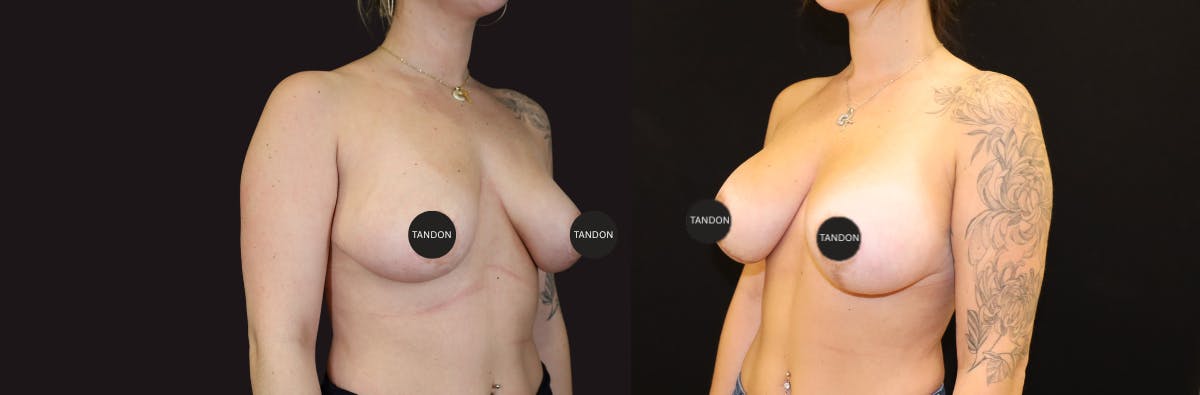 Breast Revision Before & After Gallery - Patient 277235 - Image 2