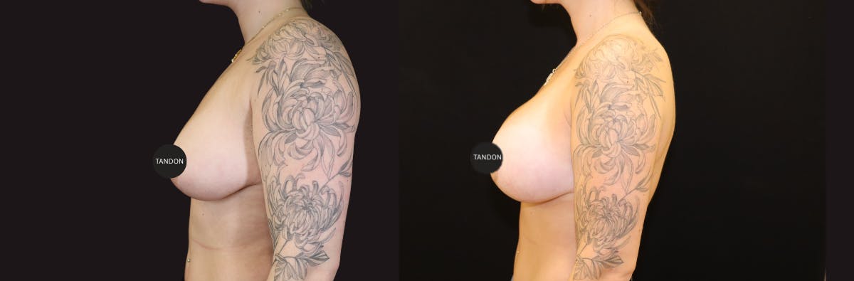 Breast Revision Before & After Gallery - Patient 277235 - Image 3