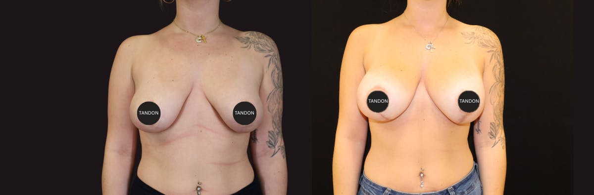 Breast Revision Before & After Gallery - Patient 277235 - Image 1