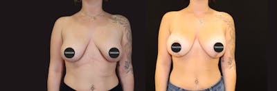 Breast Revision Before & After Gallery - Patient 277235 - Image 1