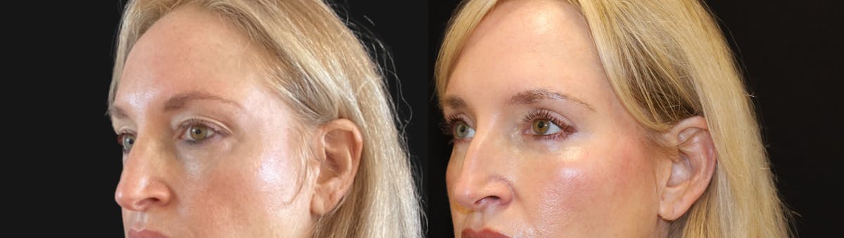 Blepharoplasty Before & After Gallery - Patient 328339 - Image 2
