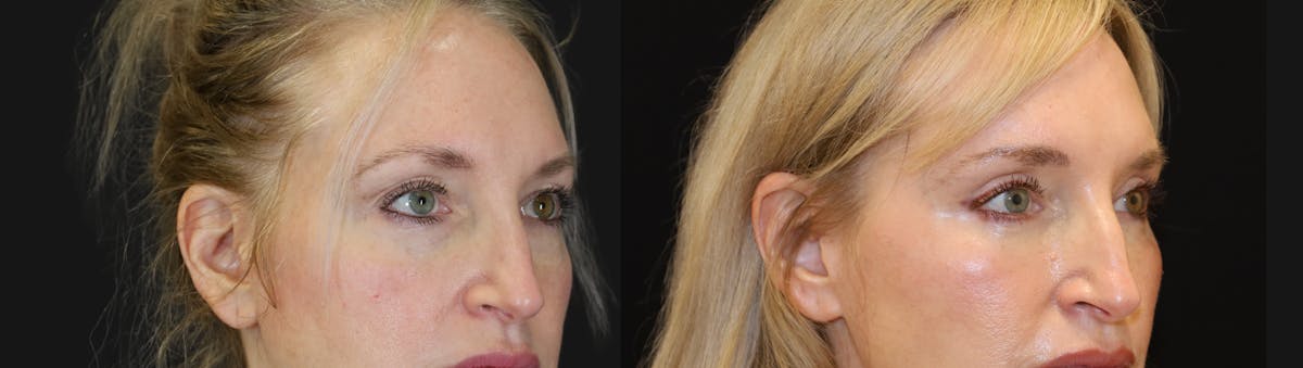 Blepharoplasty Before & After Gallery - Patient 328339 - Image 3
