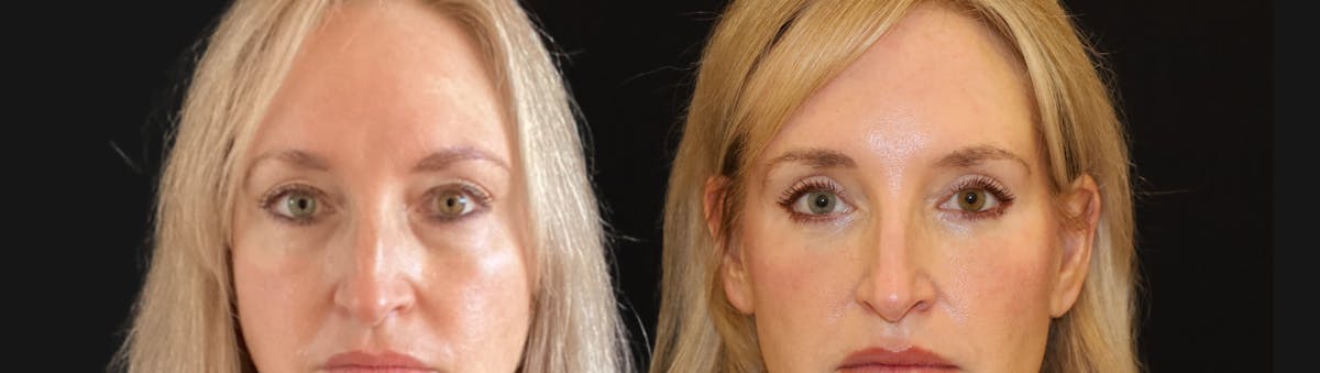 Blepharoplasty Before & After Gallery - Patient 328339 - Image 1