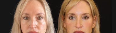 Blepharoplasty Before & After Gallery - Patient 328339 - Image 1