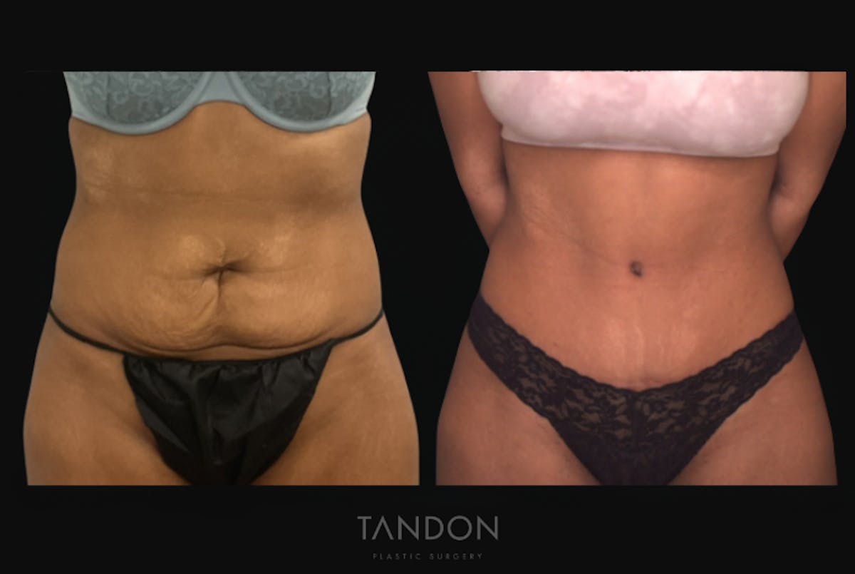 Abdominoplasty (Tummy Tuck) Before & After Gallery - Patient 198125 - Image 1