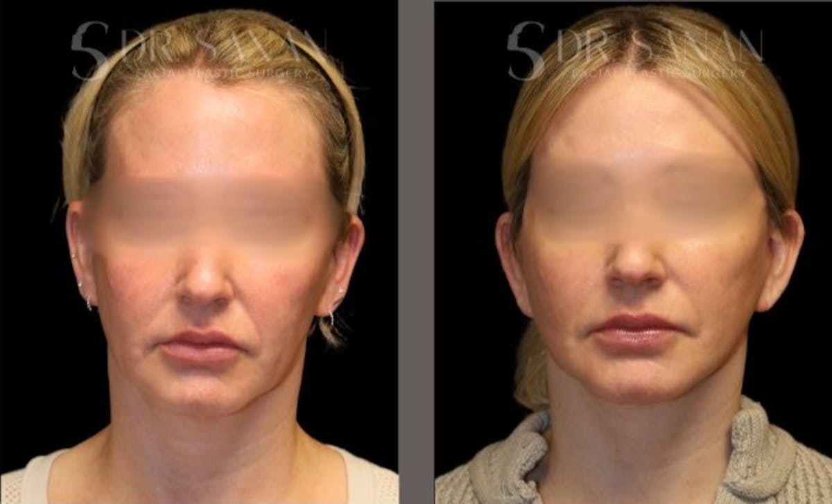Facelift Before & After Gallery - Patient 439393 - Image 4