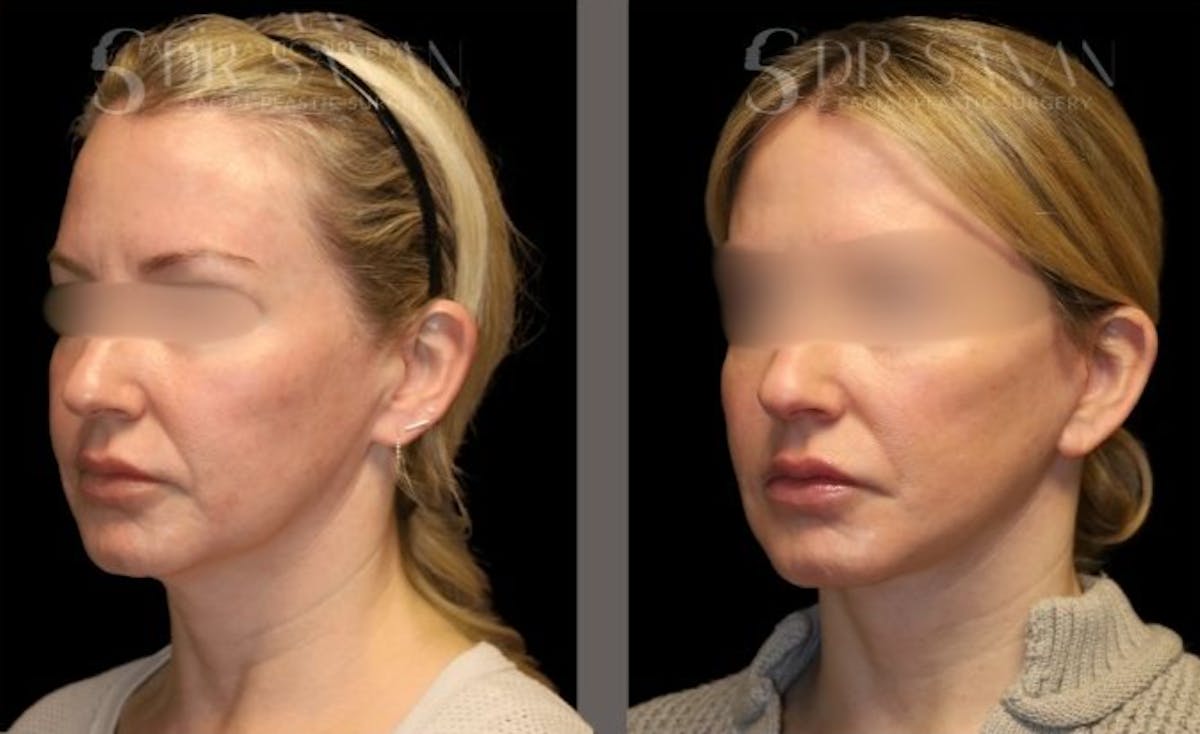 Facelift Before & After Gallery - Patient 439393 - Image 3