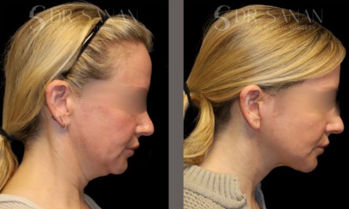 Facelift Before & After Gallery - Patient 439393 - Image 2