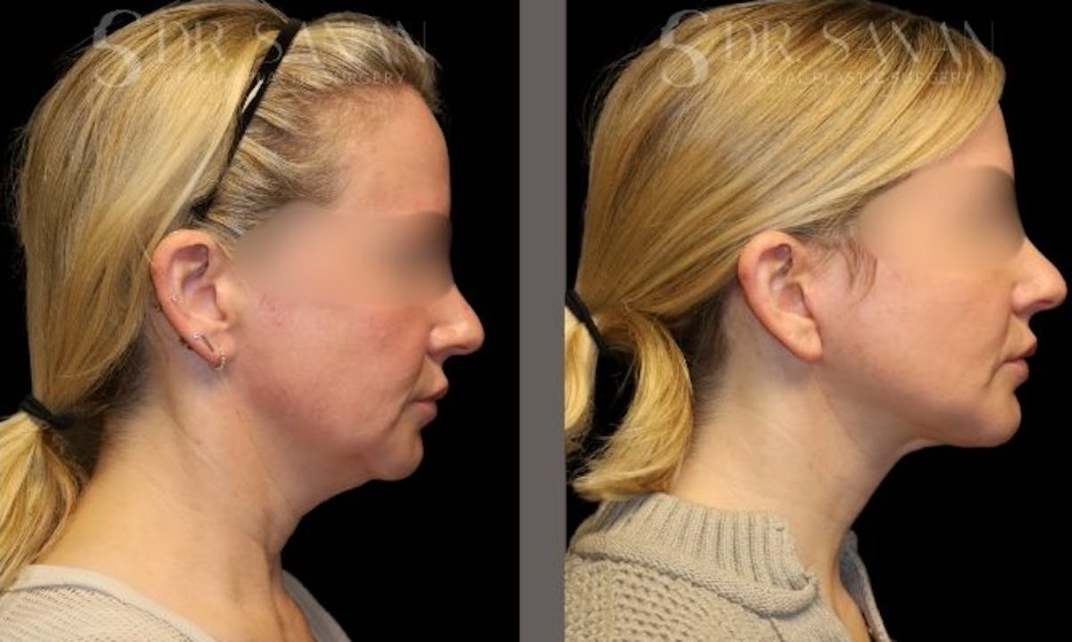 Facelift Before & After Gallery - Patient 439393 - Image 1