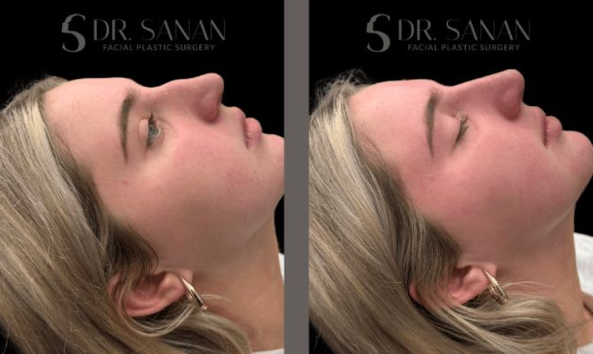 Non Surgical Rhinoplasty Before & After Gallery - Patient 327186 - Image 1