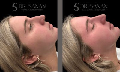 Non Surgical Rhinoplasty Before & After Gallery - Patient 327186 - Image 1