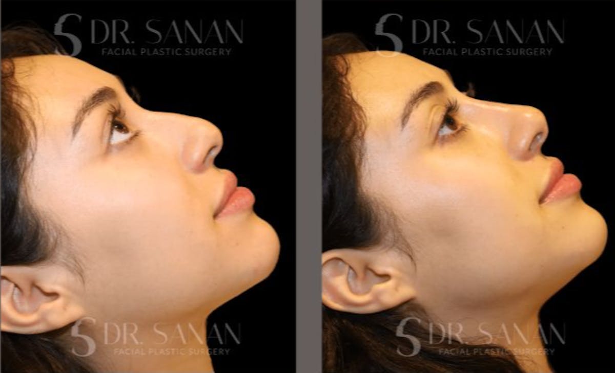 Non Surgical Rhinoplasty Before & After Gallery - Patient 144898 - Image 1