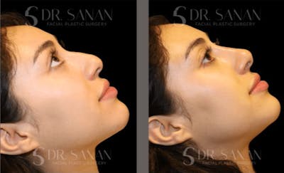 Non Surgical Rhinoplasty Before & After Gallery - Patient 144898 - Image 1