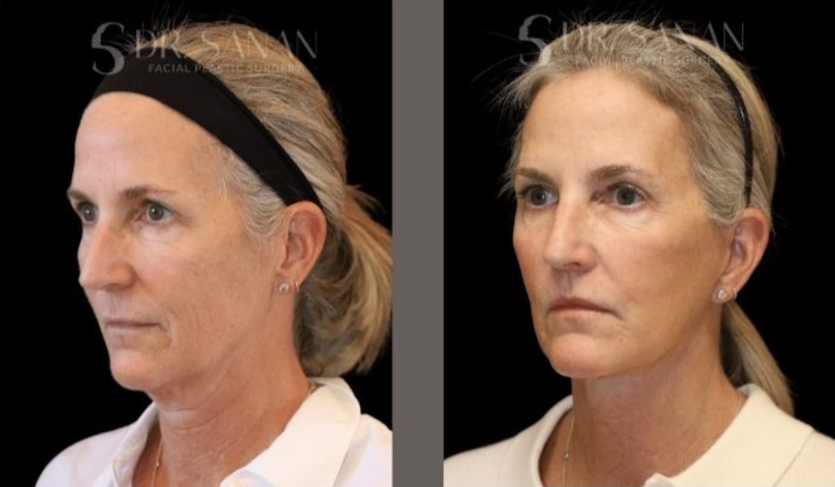 Deep Plane Facelift Before & After Gallery - Patient 332719 - Image 3